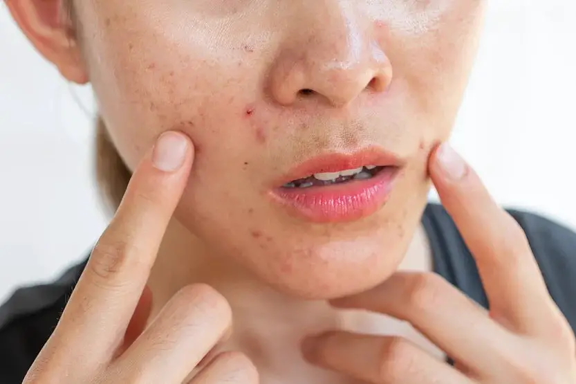 Oral Antibiotics for Folliculitis: Essential Guide for Beauticians