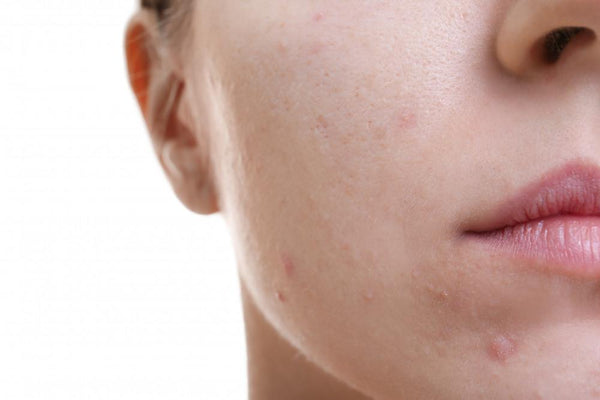 Hot Tub Use and Folliculitis Risk: What Beauticians Need to Know