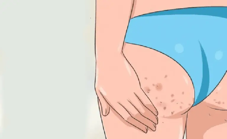 Keratosis Pilaris on Buttocks Explained: A Beautician's Guide