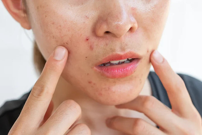 Hot Tub Folliculitis Causes: What Beauticians Should Know
