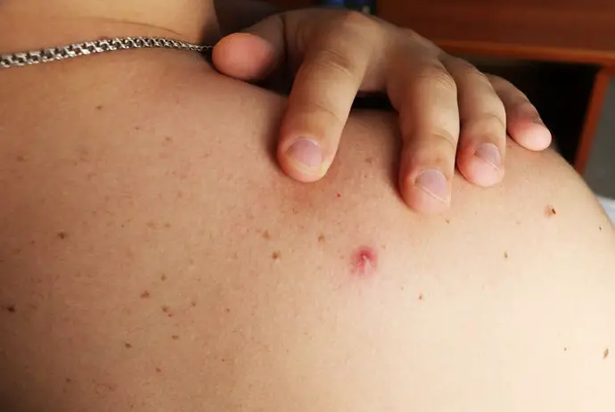 Sweat-Induced Butt Acne: Causes, Treatments, and Prevention