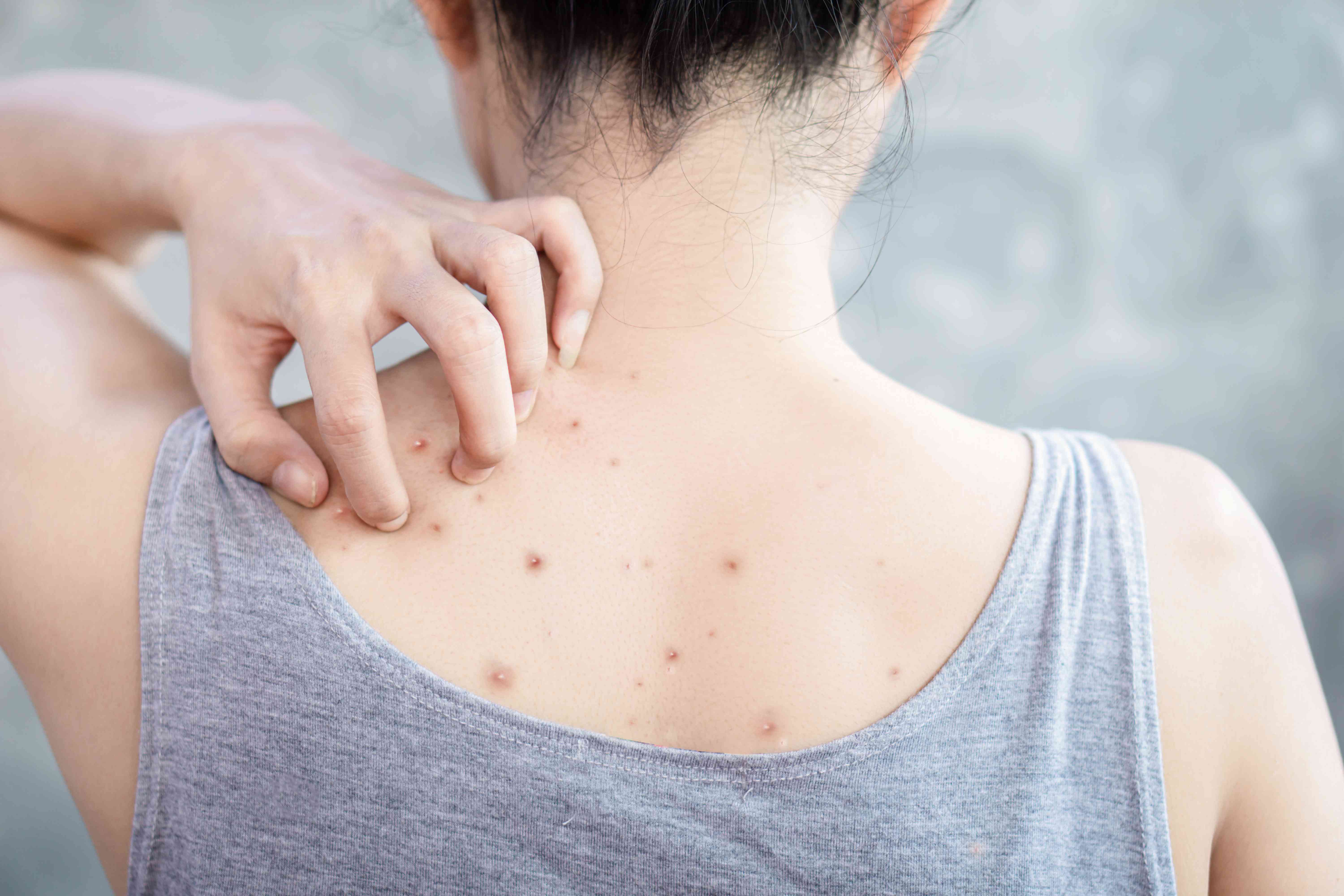 Workout Acne Prevention: Remarkable Beauty Tips Unveiled