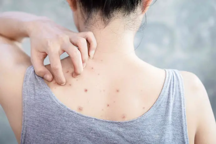 Workout Acne Prevention: Remarkable Beauty Tips Unveiled