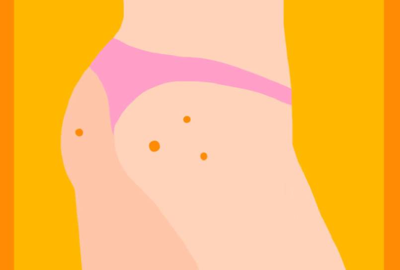 How to Get Rid of Butt Acne Scars: Tremendous Tips for Smooth Skin