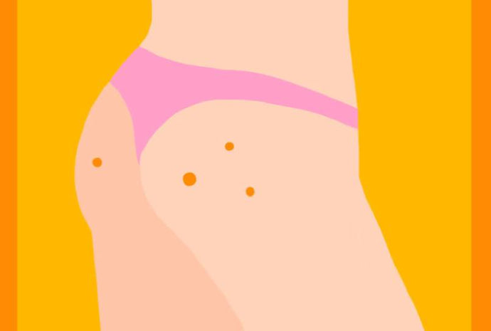 How to Get Rid of Butt Acne Scars: Tremendous Tips for Smooth Skin