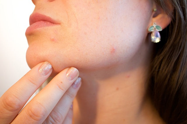 Tea Tree Oil for Folliculitis Treatment: A Natural Beauty Boost