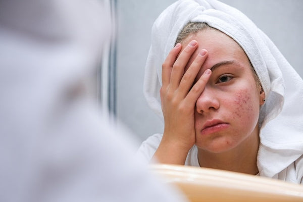 Immune System and Folliculitis: A Beautician's Perspective