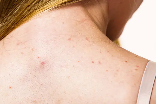 How to Cleanse Skin After Workout? Tips for Glowing Skin