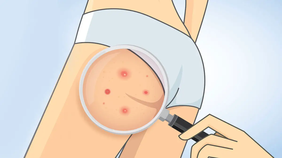 Home Remedies for Keratosis Pilaris on Butt: Beauty Tips