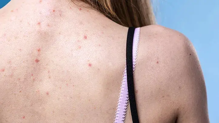 Best Underwear to Prevent Butt Acne: What Should Beauticians Know?