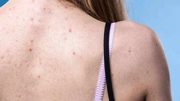 Best Laundry Detergents for Acne-Prone Skin: A Beauticians Guide