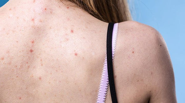 Best Laundry Detergents for Acne-Prone Skin: A Beauticians Guide