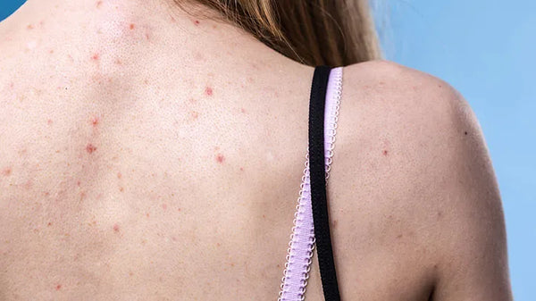 Best Underwear to Prevent Butt Acne: What Should Beauticians Know?