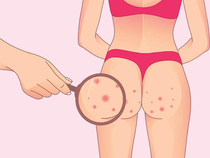 Finding the Best Powder for Butt Acne: Big Delighted Guide