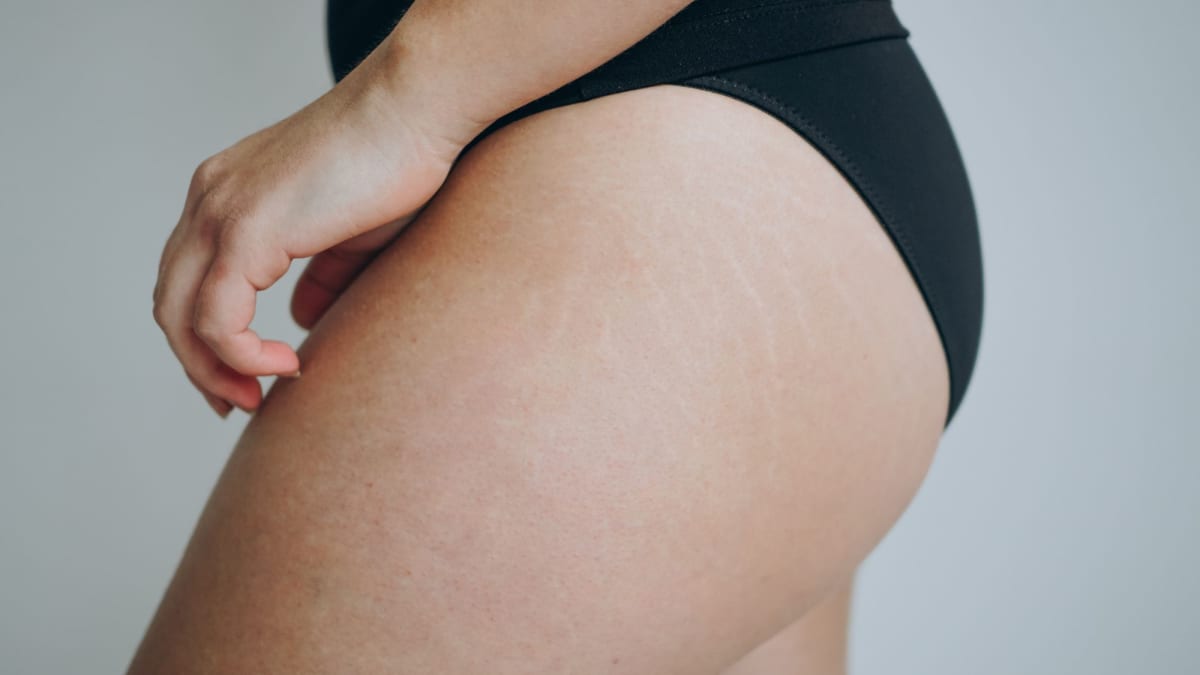 Skincare for Keratosis Pilaris on Butt: Tips & Tricks