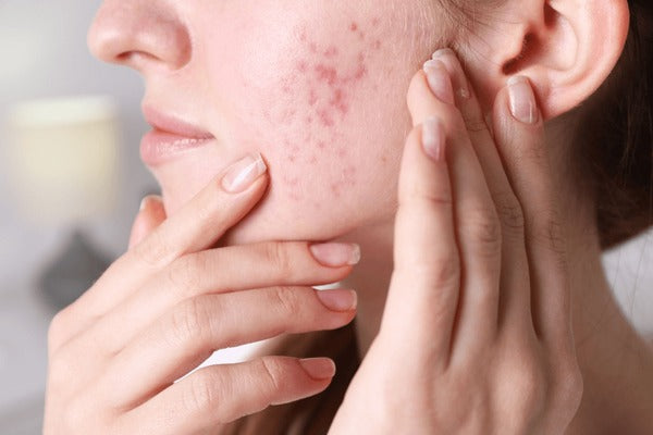 Fungal Infections Leading to Folliculitis: Know Causes and Treatments